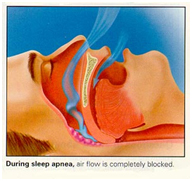 sleep apnea